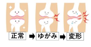 膝痛変形性膝関節症